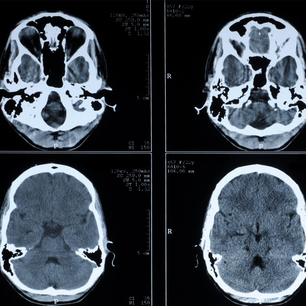 Orden Médica para Tomografía (TAC) Cerebro – Diagnóstico Rápido para Evaluar el Sistema Nervioso Central