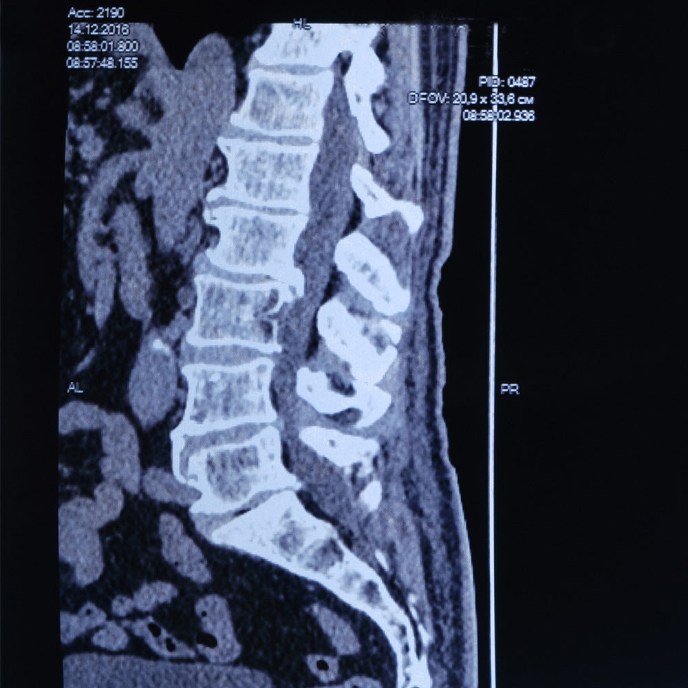 Orden Médica para Tomografía (TAC) Columna – Diagnóstico Detallado de la Columna Vertebral