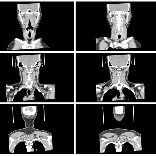 Orden Médica Tomografía (TAC) de Cuello – Diagnóstico Preciso de Lesiones y Patologías Cervicales