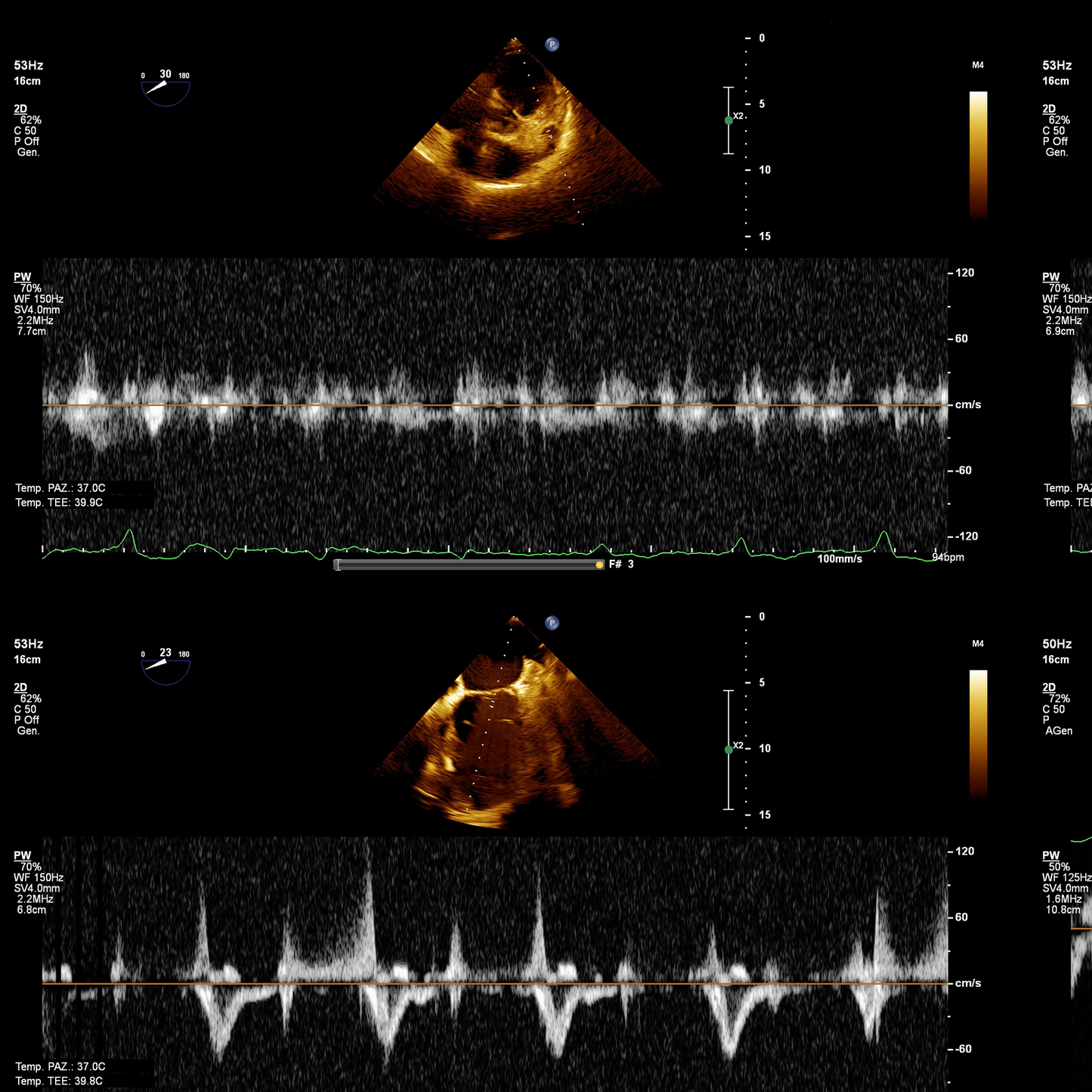 Ecocardiograma Doppler