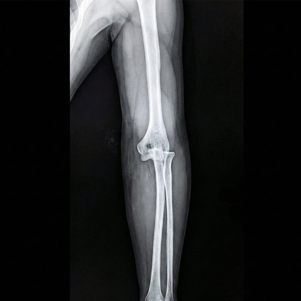 Orden Médica Radiografía de brazos y antebrazos – Evaluación de Fracturas y Lesiones Óseas