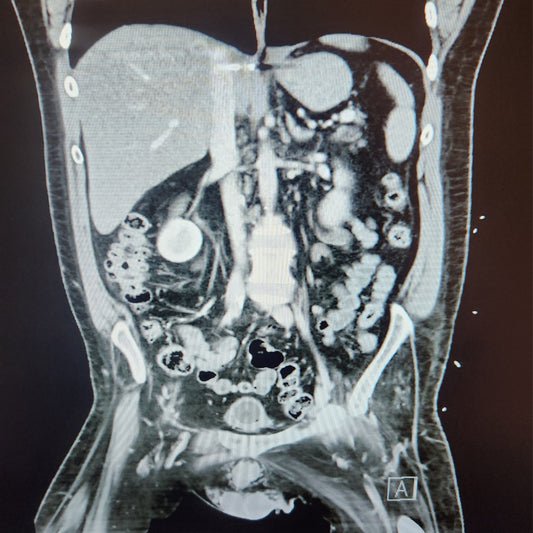Orden Médica Tomografía (TAC) de Abdomen y Pelvis – Diagnóstico Integral de Órganos Internos