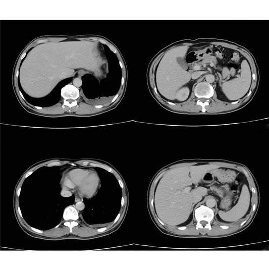 Orden Médica Tomografía de Tórax (TAC) – Diagnóstico Avanzado para Evaluar tus Pulmones y Cavidad Torácica