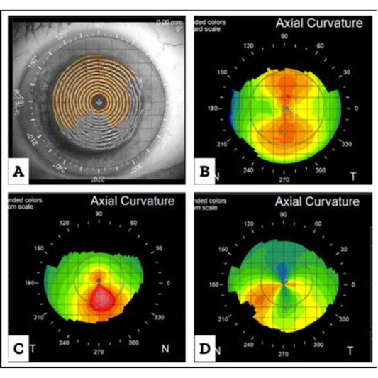 Orden Médica para Topografía Corneal Computarizada (Pentacam) – Estudio Avanzado de la Superficie Ocular