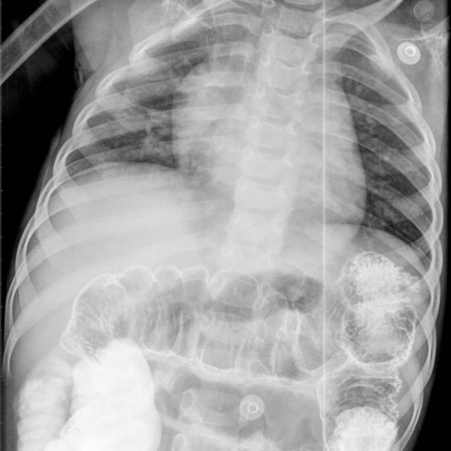 Radiografía Abdominal